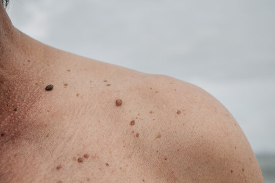 Skin texture black birthmarks and moles on the skin of an elderly man