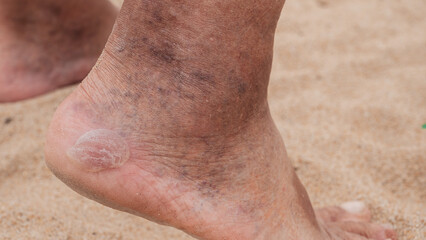 Fototapeta premium Corns, calluses on the heels of an elderly man's feet, inflamed dilated veins on his legs.