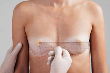 doctor measuring woman's breasts and making markings before surgery. Breast augmentation concept