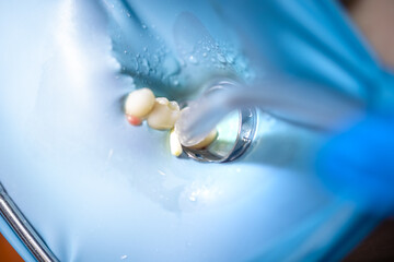 The dentist treats the child's tooth using a rubber dam. Close-up of tooth treatment.