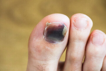 Close-up bruised nail of the big toe. Violet toenail. Injured foot.