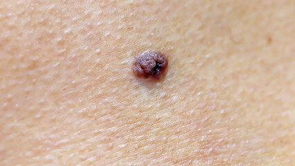 Moles and warts that appear on the body