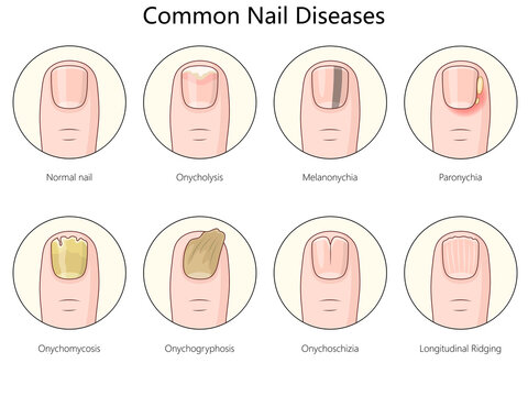 Nagelkrankheiten-Bilder: Stock-Fotos & -Videos. | Adobe Stock