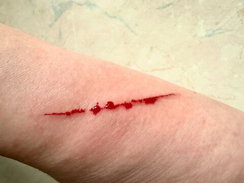 bleeding scratch on the skin of the hand