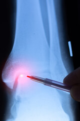 Doctor learning vertical X-ray scan of a crack in the ankle joint and talus bones.