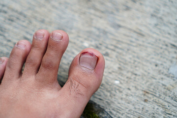 Close-up view of a minor toe injury with a small wound and slight bleeding. Injured Toe: A Close-Up View of a Minor Foot Injury