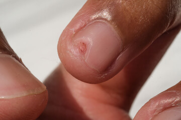 The index finger nail has an incised wound. Work accident in the kitchen which caused a finger injury. Closeup hand fingers. Macrophotography Concepts. Negative Space