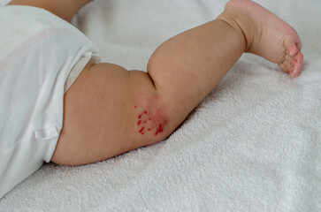 Reddish mark on a baby's leg: a hemangioma or strawberry birthmark. Hemangiomas are benign vascular...