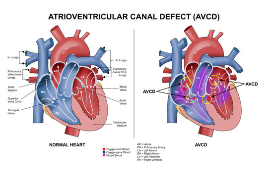 Atrioventricular Canal Defect (AVCD) Illustration