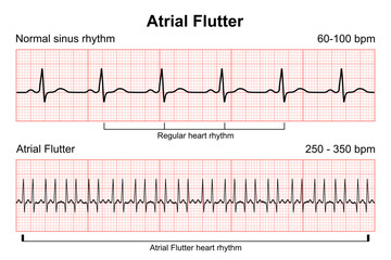 Atrial Flutter heart rhythm illustration
