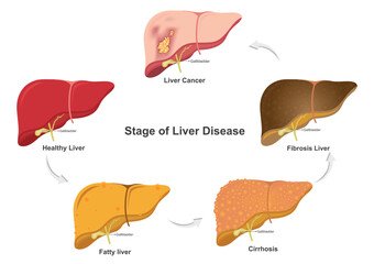 Stage of liver damage.