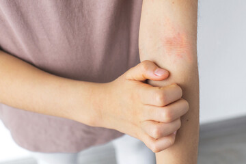 A child scratching an irritated red rash on their arm, showing symptoms of atopic dermatitis. The close-up highlights the discomfort and dry, inflamed skin, concept of health, allergies, skin diseases