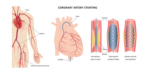 Coronary artery stenting. Scheme of coronary artery stenting using femoral artery puncture. Medical illustration of stages of stenting. Vector illustration in flat style isolated on white background.