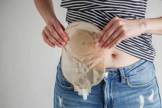 young girl holding a colonostomy near her stomach, bowel cancer concept