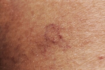 Close-up of human spider veins on leg. Varicose vien on leg. Woman's leg with varicose veins and...