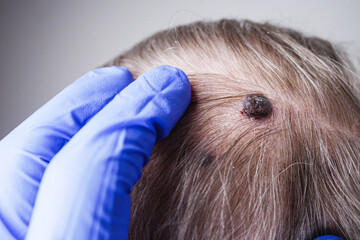 melanoma, late-stage skin cancer, on an old man's head