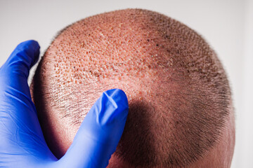 doctor examines the head of a young male patient after a hair transplant
