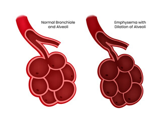 Normal alveoli vs Emphysema