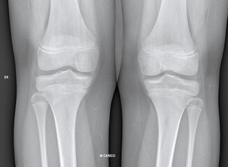 X-ray image reveals Osgood-Schlatter disease affecting knees. Captures irregular bone growth at the...