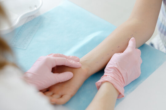 Doctor doing skin allergy test at white table in office. Allergy test - skin prick allergy testing for possible allergens