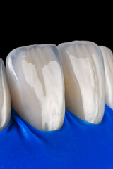 veneers fixation with rubber dam
