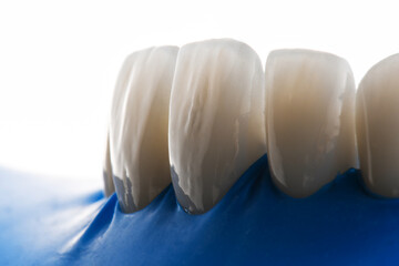 veneers fixation with rubber dam