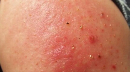 Fototapeta premium Close-up of irritated red skin showing inflammation and dryness, providing a clear depiction of skin irritation with detailed texture. 