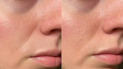 Before and After Skincare Transformation: Smooth, Radiant Skin with Wrinkle Reduction Near the Lips...
