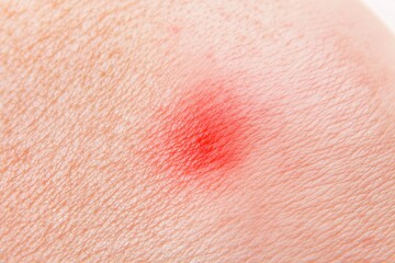 Fototapeta premium Close-up of irritated skin showing redness and inflammation, possibly indicating an allergic reaction or other skin condition requiring medical attention