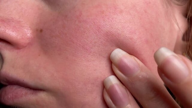 Close-Up of Woman&rsquo;s Natural Face with Healthy, Glowing Skin Featuring Mild Redness and Blemishes &ndash; Real Beauty, Imperfections, and Fresh Look Highlighting Authentic Skin Care, Radiance, and Natural Sk