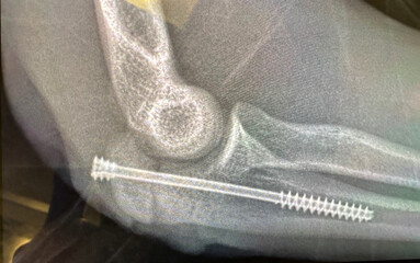 Xray of a titanium screw in elbow bone