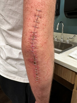 Staples being removed after surgery