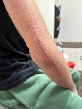 Scars from a surgery