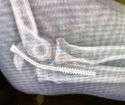 Xray of a bent  titanium screw in a broken elbow bone