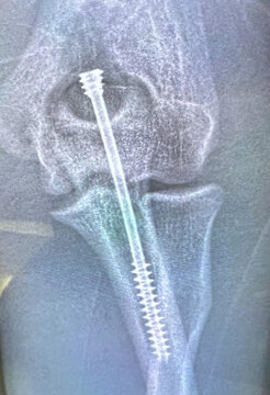 Xray of a titanium screw in elbow bone