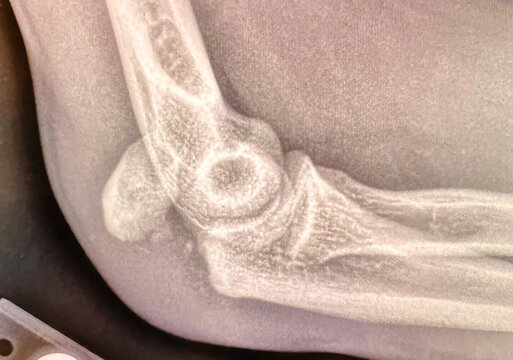 Xray of a broken  elbow bone