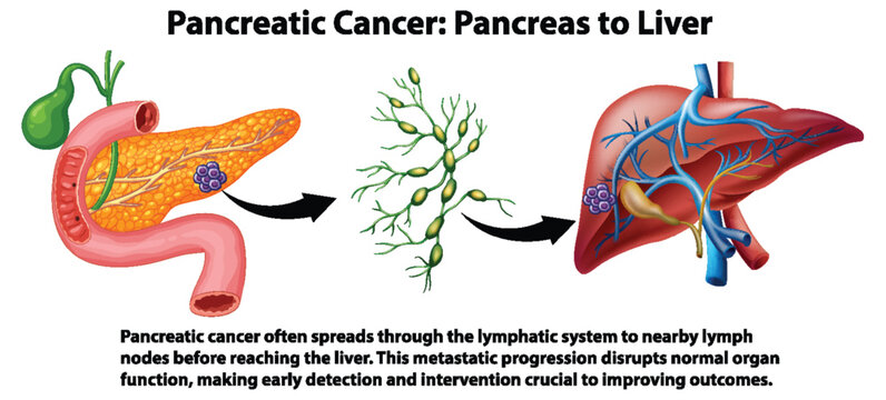 Pancreatic Cancer Metastasis to Liver