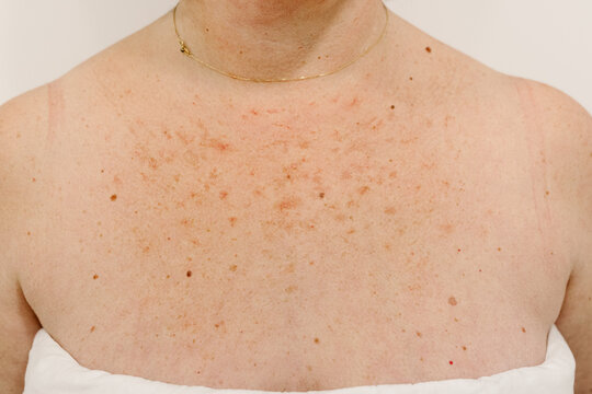Vascular lesions on the breast skin of an unknown dermatology patient