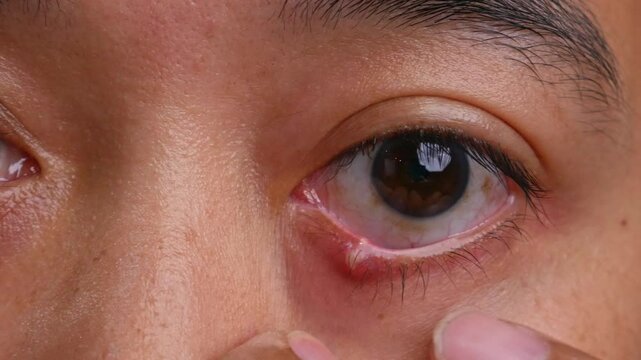 Close Up of Adult Man with one eye infection, Chalazion, Stye (hordeolum) on eyelid.