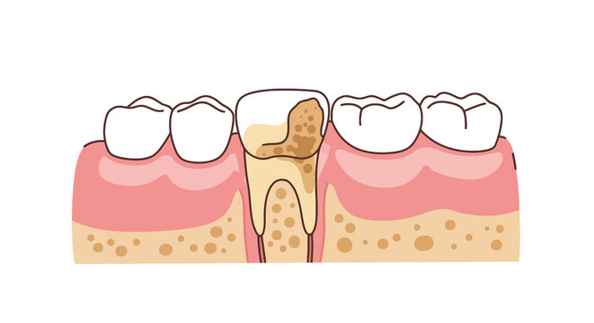 Photos of receding gums. This image shows a cross-section of teeth and gums, highlighting a tooth with receding gums and decay. Vector illustration design.