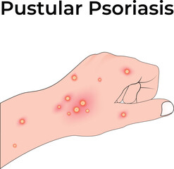 Pustular Psoriasis on Hand Design Vector Illustration