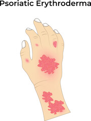 Psoriatic Erythroderma Design Vector Illustration