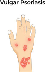 Vulgar Psoriasis on Hand Design Vector Illustration