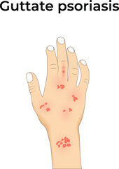 Guttate Psoriasis on Hand Design Vector Illustration