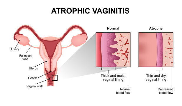 Vaginal atrophy (genitourinary syndrome of menopause or atrophic vaginitis) 