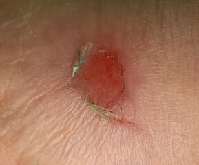 A red, scabbed area on a person's arm