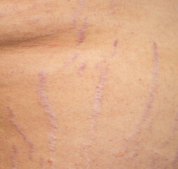 A person's skin is covered in red marks