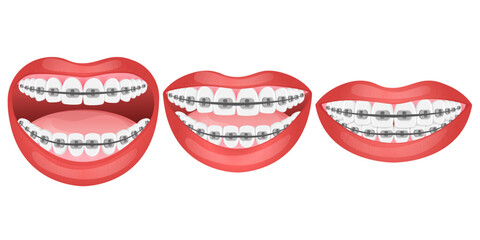 Vector image of mouth and teeth. Braces and bite correction. Dentistry and dental treatment concept. Element for your design of banners, posters, articles, etc.