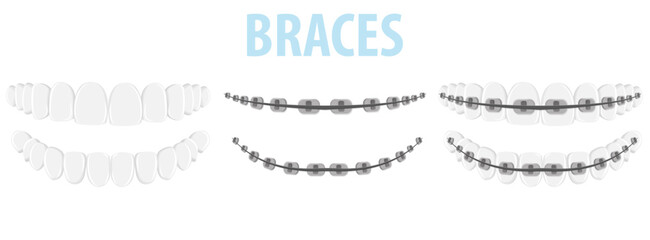 Vector image of mouth and teeth. Braces and bite correction. Dentistry and dental treatment concept. Element for your design of banners, posters, articles, etc.