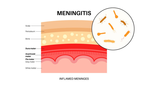 Meningitis medical poster